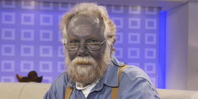 argyria