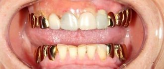 gold crowns on teeth