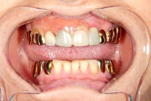 золотые коронки на зубы